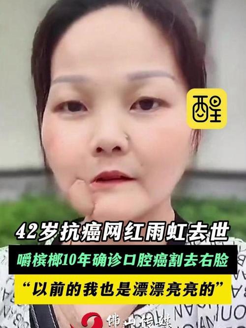 2020年免费资料大全集:嚼槟榔20年患口腔癌