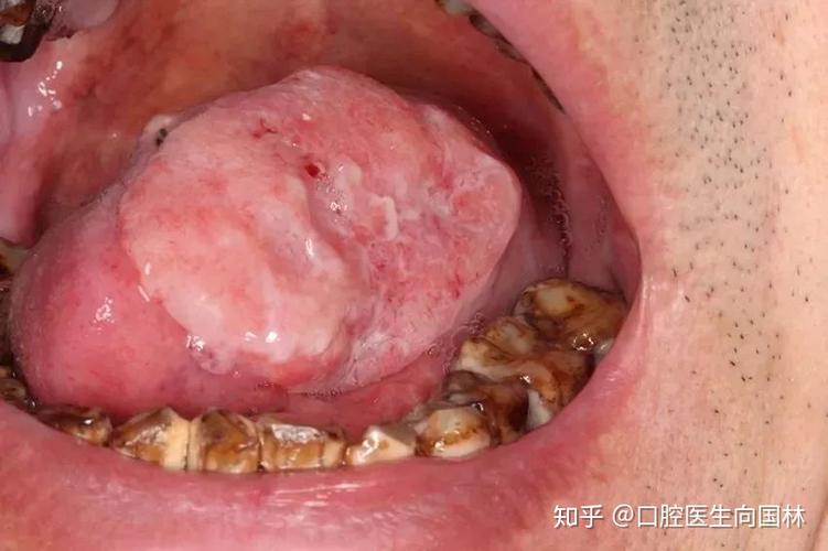 澳彩资料大全正版资料:嚼槟榔20年患口腔癌